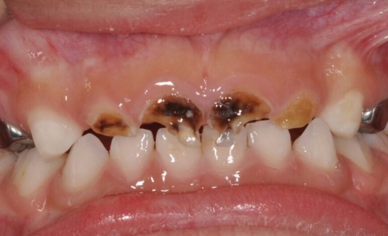 Do you know your sweet kisses could spread cavity-causing bacteria to your child?