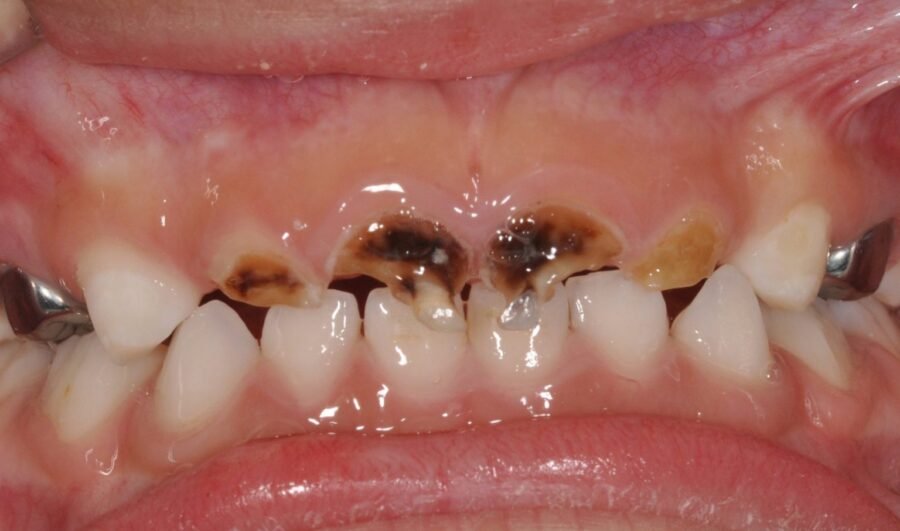 Do you know your sweet kisses could spread cavity-causing bacteria to your child?